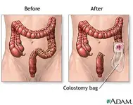 colostomy-bag.webp colostomy-bag.webp