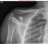 dislocated_collar_bone.webp
