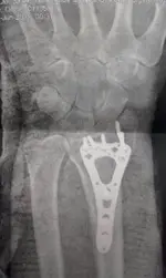 Wrist plate.webp Wrist plate.webp